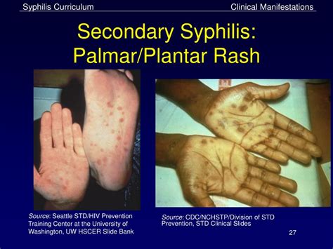 Ppt Syphilis Powerpoint Presentation Free Download Id1300224