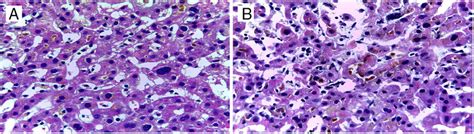 Biopsia Hepática A Dilatación Sinusoidal Con Pigmento Biliar