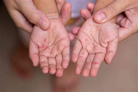 Hand Foot And Mouth Disease Hfmd Signs And Symptoms