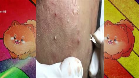 17 Satisfying Video Acne Blackheads Removal With Relaxing Music Sleep