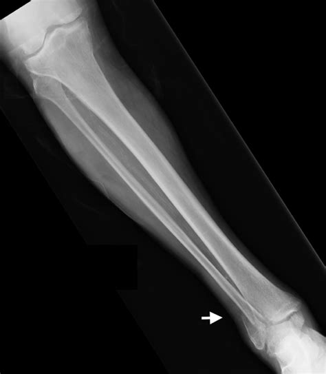 Cureus Critical Finding Of Wellens Syndrome In A Patient Who