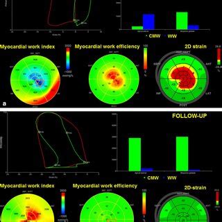 Patient With Mitral Stenosis And Lv Diastolic Dysfunction A Color