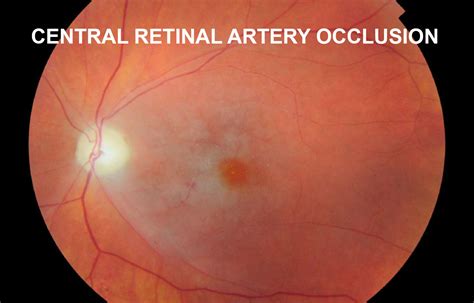 Management Of Central Retinal Artery Occlusion Scientific Statement