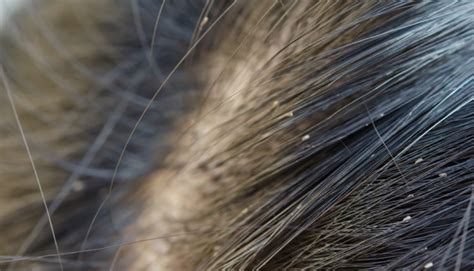 What Causes Headline To Begin In Children And What Do Lice Eggs Look Like