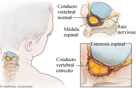 Estenosis Espinal Cervical MedicalRecords Com