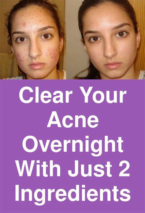 10 ways to get rid of a pimple overnight acne overnight bad acne pimples remedies