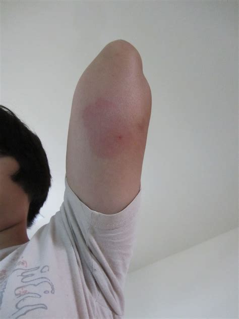 Pin On Skeeter Syndrome Pictures