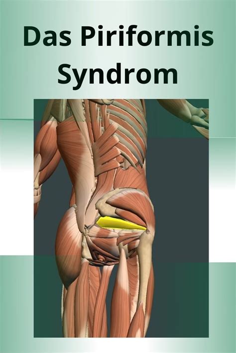 Piriformis Syndrom Piriformis Muskel Und Ischias Nerv Piriformis Muskel Ischias Piriformis