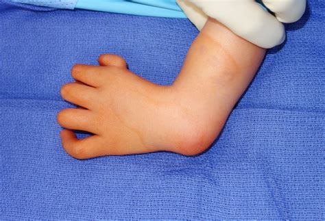 Congenital Hand And Arm Differences