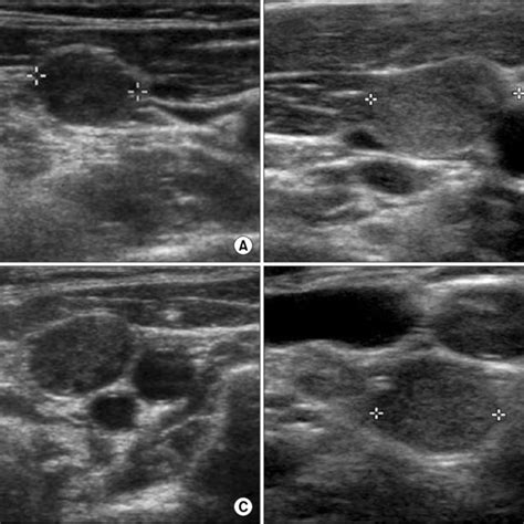 Ultrasound Images Of Central Lymph Node Metastasis A Lnm With A Loss