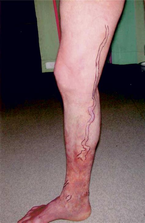Stroke After Varicose Vein Foam Injection Sclerotherapy Journal Of