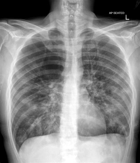 Emphysema Chest X Ray Medbabe