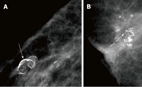 Fat Necrosis Breast Mammogram