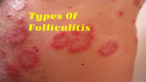 Folliculitis Symptoms Causes And Different Types Including Risk Factors