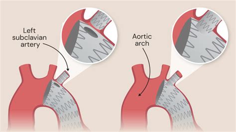 Thoracic Endovascular Aortic Repair Tevar Procedure Rb Hh