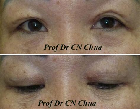 Eyelid Surgery By Prof Dr Cn Chua 蔡鐘能 The Double Eyelids My Friend Gave Me