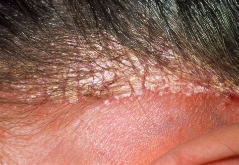 Severe Dandruff On The Scalp Of 22 Year Old Woman Stock Image M140