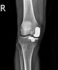 膝蓋內側軟骨磨損 「活動半膝人工關節置換」搞定 - 自由健康網