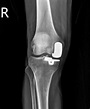膝蓋內側軟骨磨損 「活動半膝人工關節置換」搞定 - 自由健康網