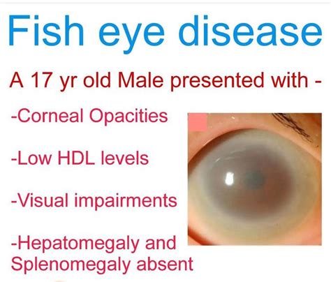 Fish Eye Disease Medizzy