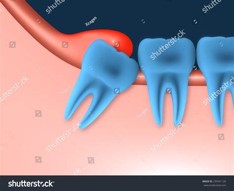 Problems Caused By Impacted Wisdom Teeth Stock Illustration 239341120