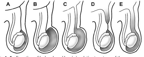 Figure 1 From Pediatric Inguinal Hernias Hydroceles And Undescended