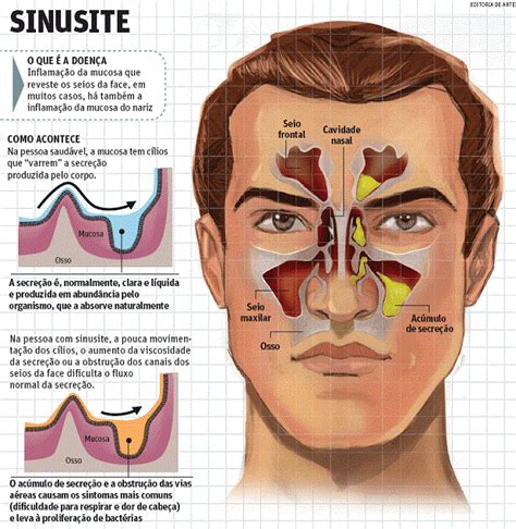 Pediatria Para Todos O Que é A Sinusite