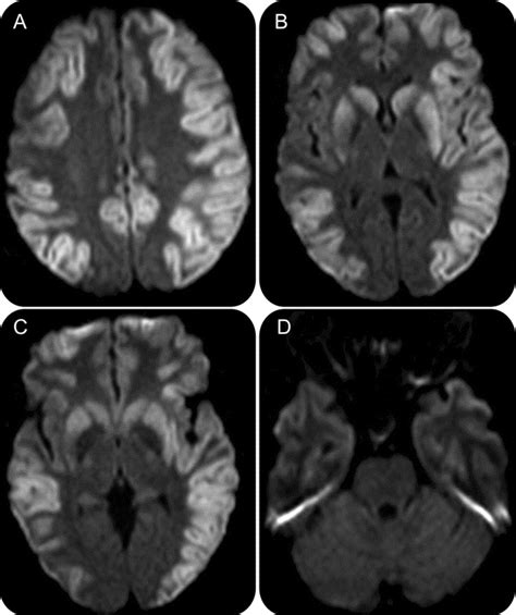 Hypoxic Brain Injury Sparing The Posterior Circulation Neurology