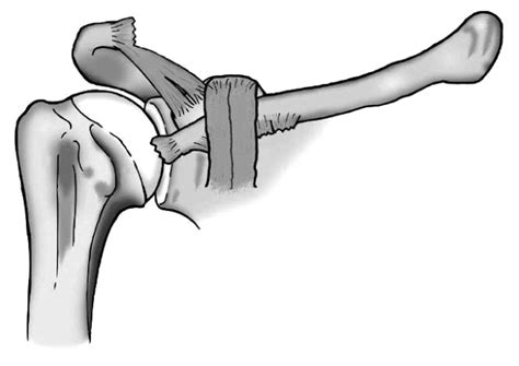 Injuries To The Acromioclavicular Joint Bone And Joint