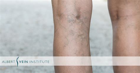 How Long Does Varicose Vein And Spider Vein Removal Take