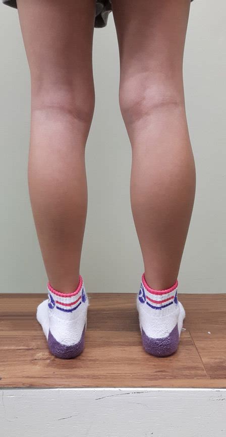 Image Showing The Patients Calves The Left Calf Circumference Is