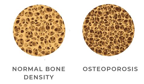 Image Showing Normal Bone Density Vs Osteoporosis Imaging Center