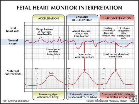 Fetal Heart Monitor Interpretation Nursing School Tips Pediatric