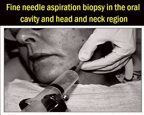 Pdf Fine Needle Aspiration Biopsy In The Oral Cavity And Head And Neck