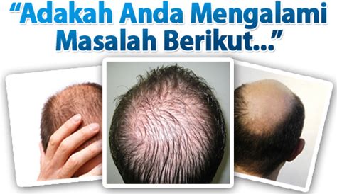 Pelbagai punca rambut gugur dan faktor yang mempengaruhi keguguran rambut.masalah kehilangan rambut kian meningkat dan apakah sebabnya? Punca dan Penyelesaian Masalah Rambut Gugur ~ Along Misuari