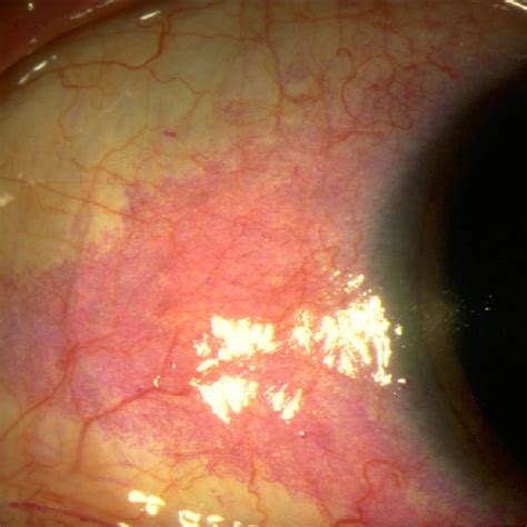 Pdf Making The Diagnosis Of Sjögrens Syndrome In Patients With Dry Eye