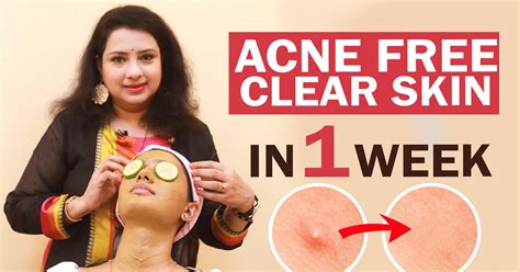 remove pimple and acne in 1 week easy facepack overnight pimple vikatan