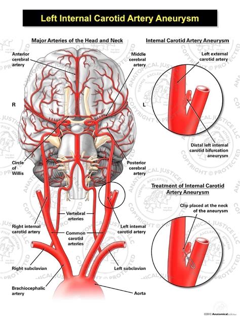 Internal Carotid Artery Model