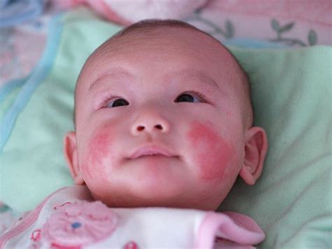 Baby Eczema Symptoms Causes Treatments And Triggers