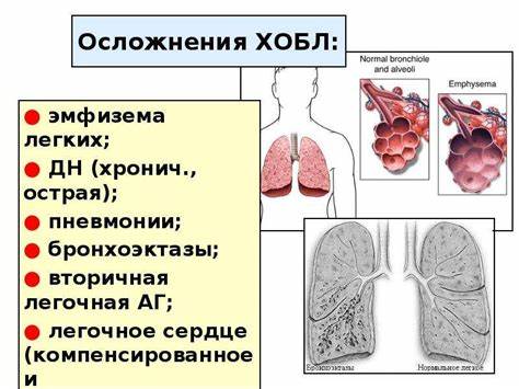 Хронический бронхит и диеты Хронический бронхит и диеты