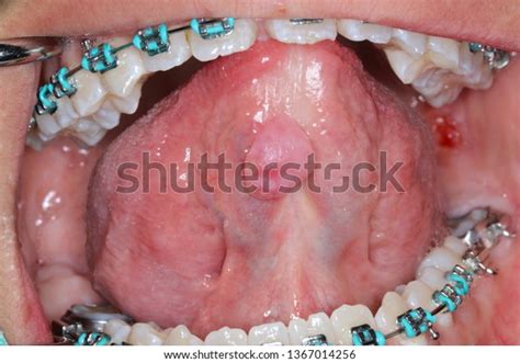Ranula Cyst Ventral Tongue Stock Photo 1367014256 Shutterstock