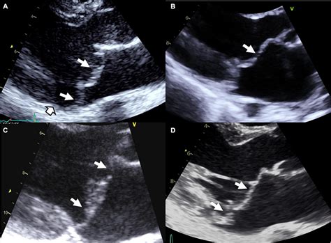 Syndromic And Non Syndromic Mitral Valve Prolapsedystrophy A Marfan