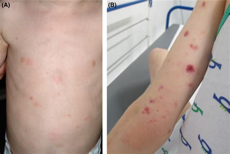 A Child With Mastocytosis And Lymphomatoid Papulosis Lange 2016