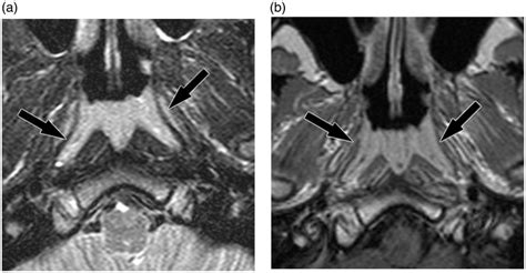 Mri Of Nasopharyngeal Adenoid Hypertrophy Abstract Europe Pmc