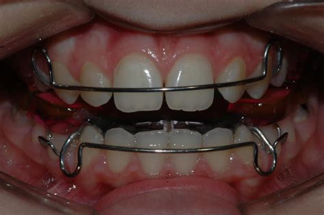 ortodonzia roma cura anomalie postura denti apparecchi