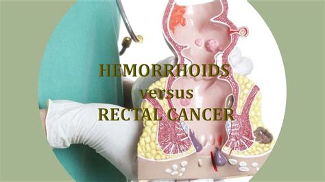 Hemorrhoids Vs Rectal Cancer Youtube