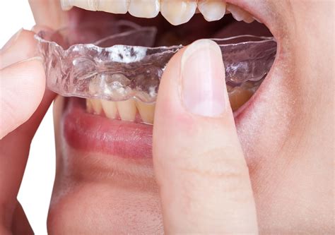 Dental Clear Aligners London ON Perfect Solutions Misaligned Teeth