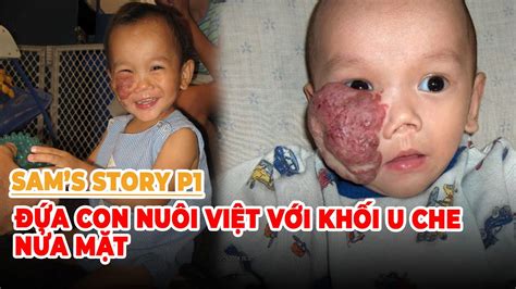 Việt Bao La Sams Story P1 Đứa Con Nuôi Việt Với Khối U Che Nửa Mặt