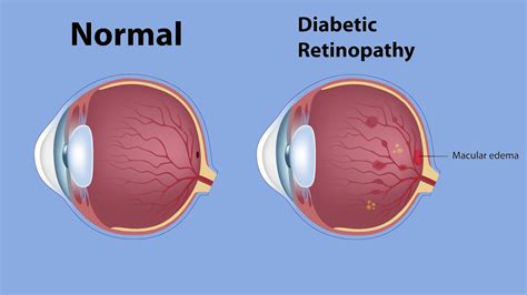What Is Diabetic Macular Edema Symptoms Causes Diagnosis Treatment