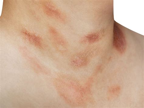 Pityriasis Rosea Causes Picture Symptoms And Treatment Images